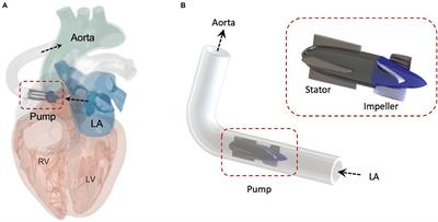 A Multi-Domain Simulation Study of a Pulsatile-Flow Pump Device for Heart Failure With Preserved Ejection Fraction